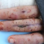 A Gruesome Flesh-Eating Bug